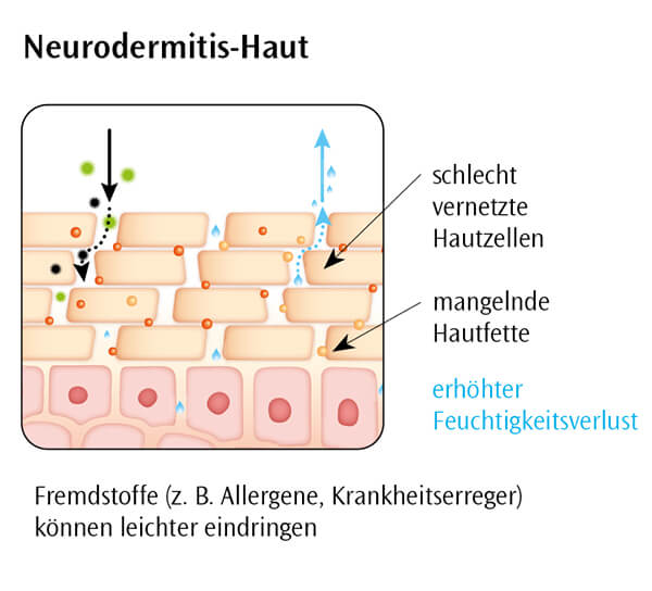neurodermitis-haut-grafik
